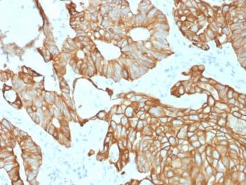 IHC testing of FFPE human colon carcinoma with recombinant CK19 antibody (clone rKRT19/800). Require
