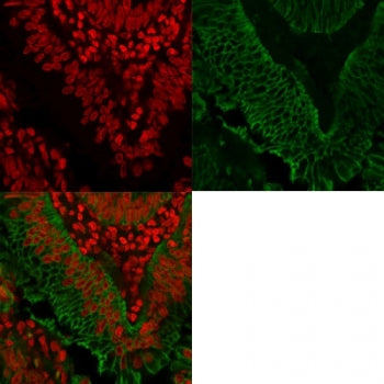 Immunofluorescent staining of FFPE human colorectal carcinoma with anti-EpCAM antibody (green) and R