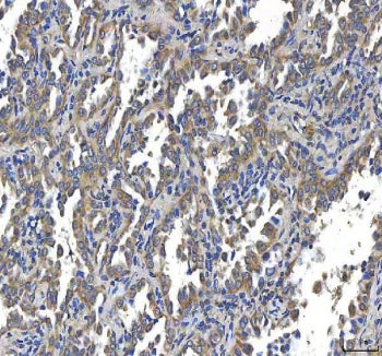 IHC staining of FFPE human lung cancer tissue with HTT antibody. HIER: boil tissue sections in pH8 E