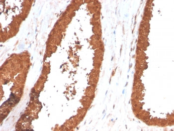 IHC staining of FFPE human prostate carcinoma with TIGIT antibody (clone TIGIT/3017). HIER: boil tis