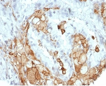 IHC staining of FFPE human colon carcinoma tissue with recombinant IL-2 antibody (clone IL2/7050R). 