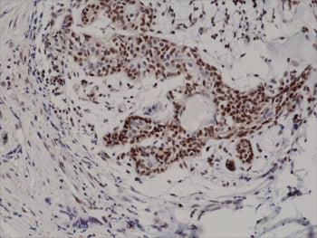 IHC testing of formalin fixed and paraffin embedded human breast cancer tissue with recombinant p27 