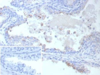 IHC staining of FFPE human prostate cancer tissue with ABCC4 antibody (clone ABCC4/9019). Inset: PBS