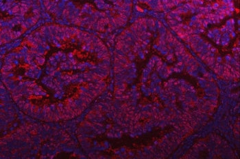 Immunofluorescent staining of FFPE human intestinal cancer tissue with PSMD4 antibody (red) and DAPI