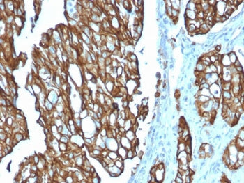 IHC testing of FFPE human colon carcinoma with TROP2 antibody (clone TACSTD2/2151). Required HIER: b