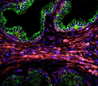 Confocal immunofluorescent analysis of Cytokeratin-18 antibody with prostate carcinoma followed by A