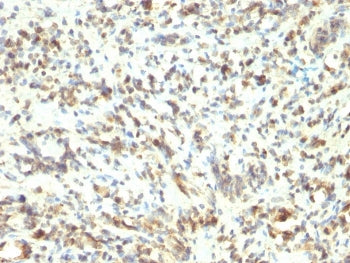 IHC staining of FFPE human Rhabdomyosarcoma with MyoD1 antibody (clone 5.8A). HIER: boil tissue sect
