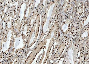 IHC staining of FFPE human prostate cancer tissue with OTT1 antibody. HIER: boil tissue sections in 