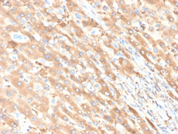 IHC staining of FFPE human liver carcinoma in colon tissue with ALB antibody (clone ALB/6411R). HIER