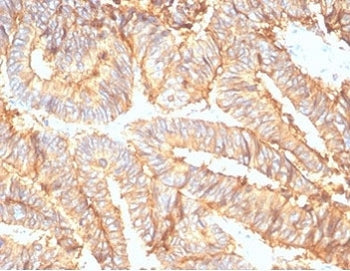 IHC staining of FFPE human colon carcinoma tissue with recombinant EpCAM antibody (clone rEGP40/7133