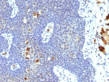 IHC staining of FFPE human cervix tissue with HPV-16 antibody (clone 4B12). Inset: PBS used in place