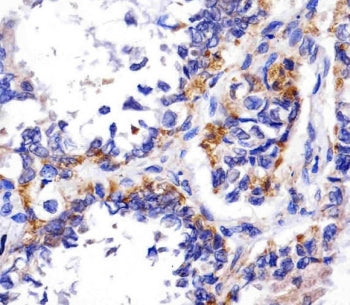IHC testing of FFPE human adenocarcinoma tissue with REDD-1 antibody. HIER: steam section in pH6 cit