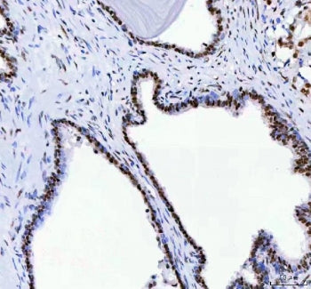 IHC staining of FFPE human prostatic acinar adenocarcinoma tissue with DDX1 antibody. HIER: boil tis