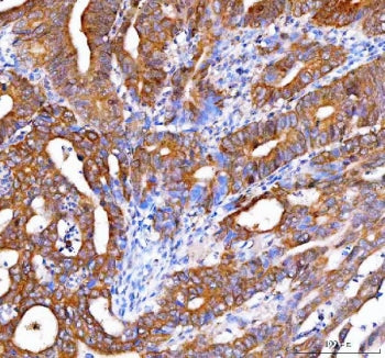 IHC staining of FFPE human rectum adenocarcinoma tissue with OTUB1 antibody. HIER: boil tissue secti