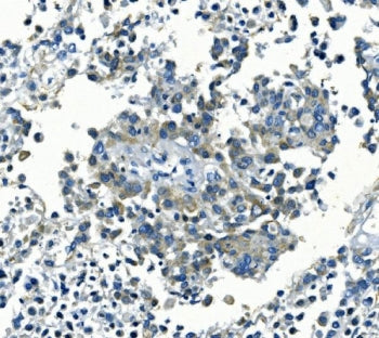 IHC staining of FFPE human pancreatic cancer with KCNJ8 antibody. HIER: boil tissue sections in pH8 
