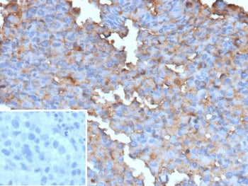 IHC staining of FFPE human melanoma tissue with recombinant BRAF V600E antibody (clone BRAF-V600E/13
