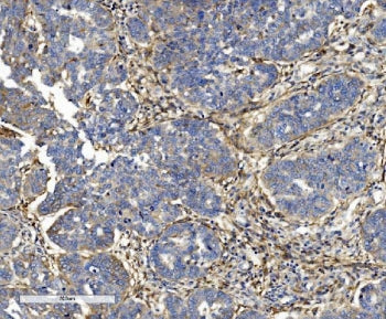 IHC staining of FFPE human ovarian serous adenocarcinoma tissue with ITGB5 antibody. HIER: boil tiss