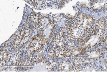 IHC staining of FFPE human renal clear cell carcinoma with KCNQ5 antibody. HIER: boil tissue section