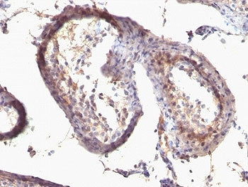 IHC: Formalin-fixed, paraffin-embedded human testicular carcinoma stained with anti-TGF alpha antibo