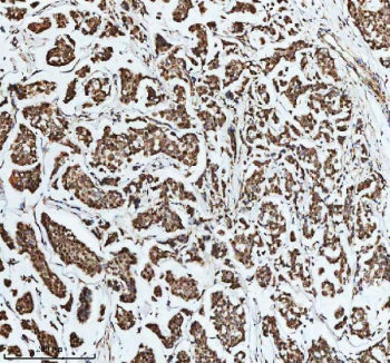 Immunohistochemical staining of DIS3 using anti-DIS3 antibody. DIS3 was detected in a paraffin-embed