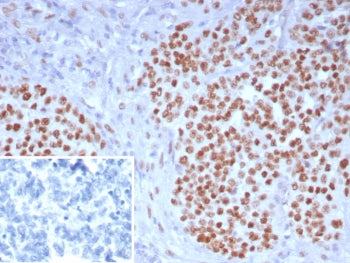 IHC staining of FFPE human ovarian carcinoma tissue with WT1 antibody (clone WT1/7715). Inset: PBS u