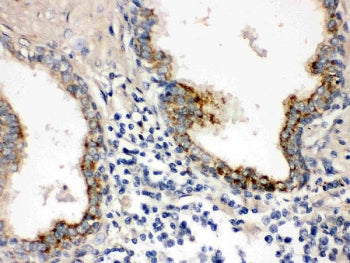 IHC testing of FFPE human prostate cancer with PTP4A2 antibody. HIER: Boil the paraffin sections in 