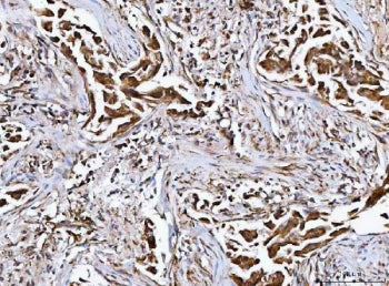 IHC staining of FFPE human breast cancer tissue with MFAP3 antibody. HIER: boil tissue sections in p