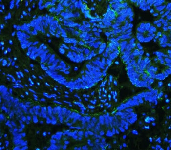 Immunofluorescent staining of FFPE human intestinal cancer with ITGB4 antibody (green) and DAPI (blu