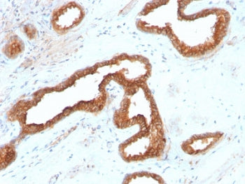 IHC testing of FFPE human renal cell carcinoma with recombinant AMACR antibody. Required HIER: steam