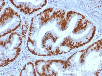 IHC testing of human endometrial carcinoma stained with Estrogen Receptor alpha antibody (clone ESR1
