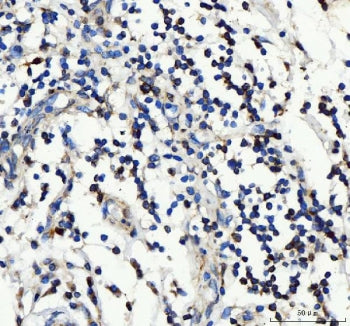 IHC staining of FFPE human lymph cancer tissue with IL2RA antibody. HIER: boil tissue sections in pH
