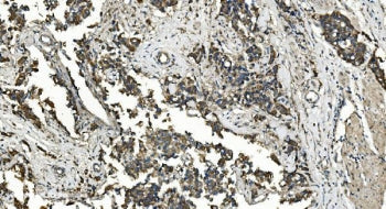 IHC staining of FFPE human bladder cancer with Folliculin antibody. HIER: boil tissue sections in pH