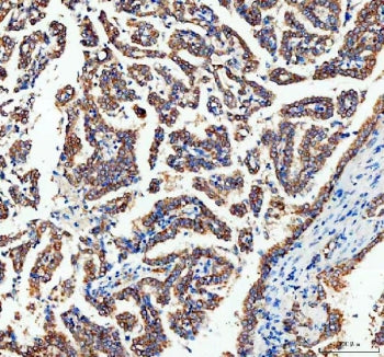 IHC staining of FFPE human lung adenocarcinoma tissue with AK1 antibody. HIER: boil tissue sections in pH8 EDTA for 20 min and allow to cool before testing.