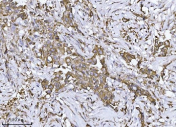 IHC staining of FFPE human breast cancer tissue with SCA2 antibody. HIER: boil tissue sections in pH