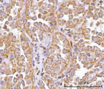 IHC staining of FFPE human lung cancer tissue with TRNT1 antibody. HIER: boil tissue sections in pH8