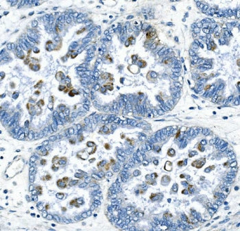 IHC staining of FFPE human ovarian cancer with Cyclin B2 antibody. HIER: boil tissue sections in pH8