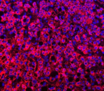 Immunofluorescent staining of FFPE human liver cancer with TTLL2 antibody (red) and DAPI nuclear sta