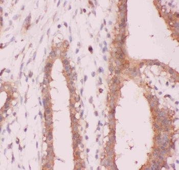 IHC staining of FFPE human breast cancer tissue with NFKB2 antibody. HIER: boil tissue sections in p