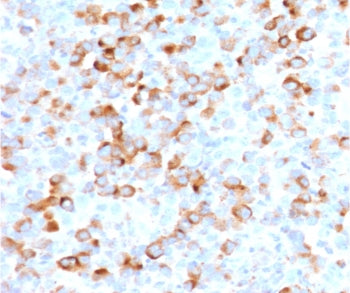 IHC staining of FFPE human melanoma with recombinant Tyrosinase antibody (clone TRSN1-2R). Required 