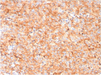 IHC staining of FFPE human melanoma with CD63 antibody (clone LAMP3/3315). HIER: boil tissue section