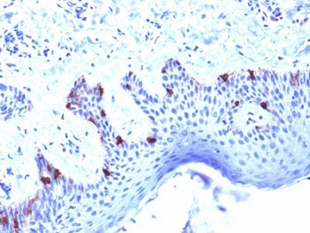 IHC testing of human skin with Melanoma gp100 antibody (clone PMEL/2039). Required HIER: boil tissue