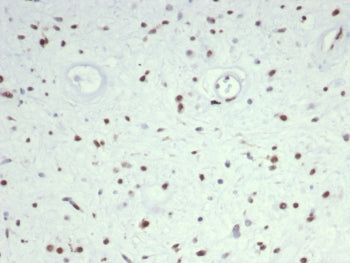 IHC staining of FFPE human rhabdomyosarcoma tissue with MyoD1 antibody (clone MYOD1/7149). HIER: boi