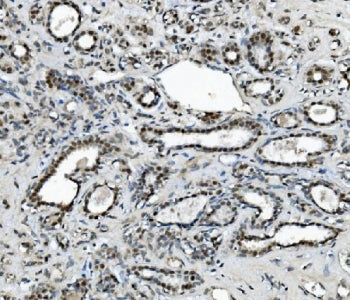 IHC staining of FFPE human breast cancer with METTL1 antibody. HIER: boil tissue sections in pH8 EDT