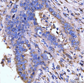 IHC staining of FFPE human appendiceal adenocarcinoma tissue with Giantin antibody. HIER: boil tissu