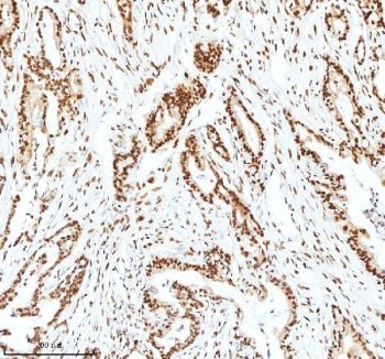 IHC staining of FFPE human pancreas ductal adenocarcinoma tissue with Ku70 antibody. HIER: boil tiss
