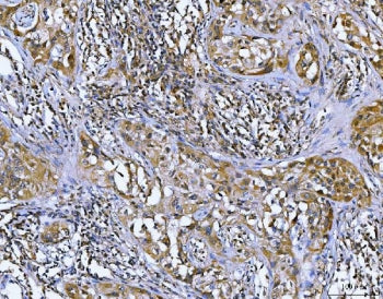 IHC staining of FFPE human lymph node carcinoma tissue with Bcl10 antibody. HIER: boil tissue sectio