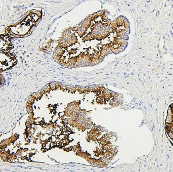 IHC staining of FFPE human prostate cancer with RAB27A antibody. HIER: boil tissue sections in pH6, 