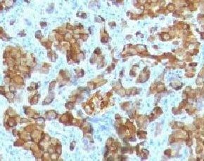 IHC: Formalin-fixed, paraffin-embedded human melanoma stained with Melan-A antibody (clione MRT3V). 