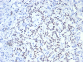 IHC staining of FFPE human pancreatic cancer with PAX6 antibody (clone PAX6/7708). HIER: boil tissue