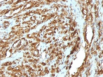 IHC: Formalin-fixed, paraffin-embedded human rhabdomyosarcoma stained with pan Muscle Actin antibody